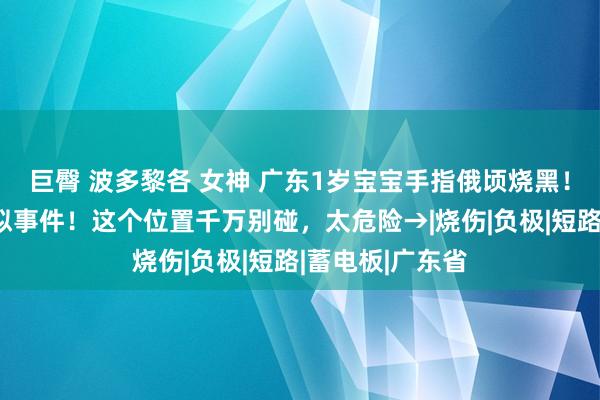 巨臀 波多黎各 女神 广东1岁宝宝手指俄顷烧黑！多地已发生近似事件！这个位置千万别碰，太危险→|烧伤|负极|短路|蓄电板|广东省